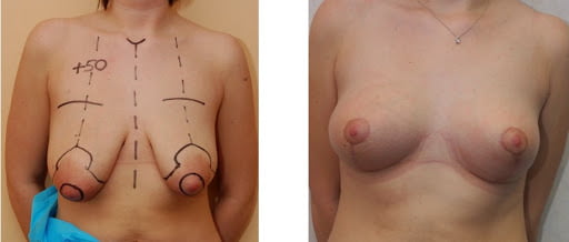 Фото до і після збільшення грудей