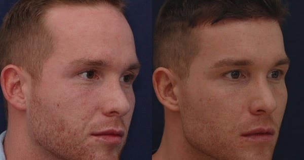 abaissement de la ligne frontale chez l'homme