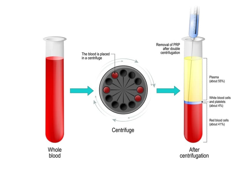 Traitement PRP et purification du sang