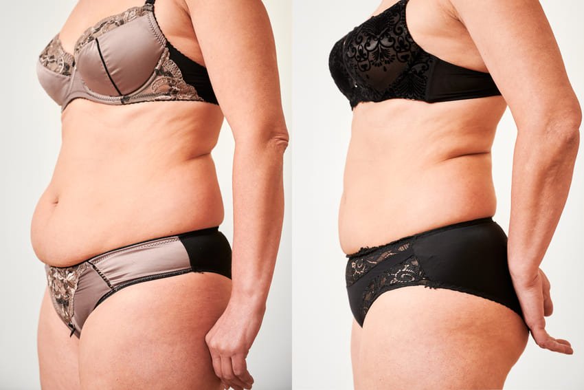 Résultat avant et après d'une abdominoplastie d'une femme