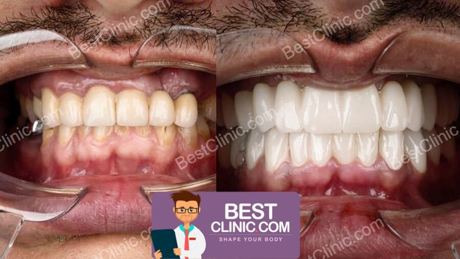 avant apres facette dentaire turquie