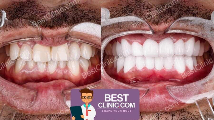 avant apres facette dentaire turquie