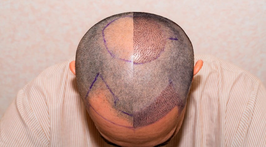 Résultat avant et après la greffe de cheveux