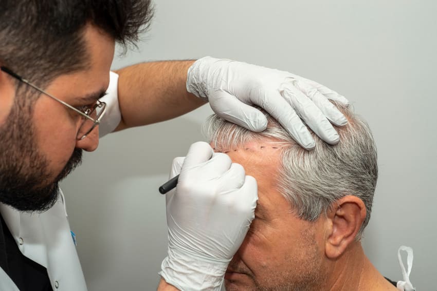 Tracé de la ligne de la greffe capillaire par le chirurgien