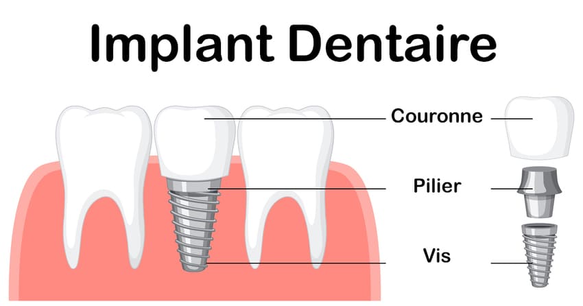 Schéma d'implant dentaire avec la couronne, le pilier et la vis.